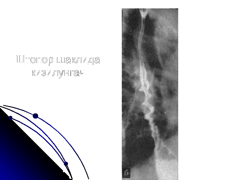 Штопор шаклида кизилунгач 