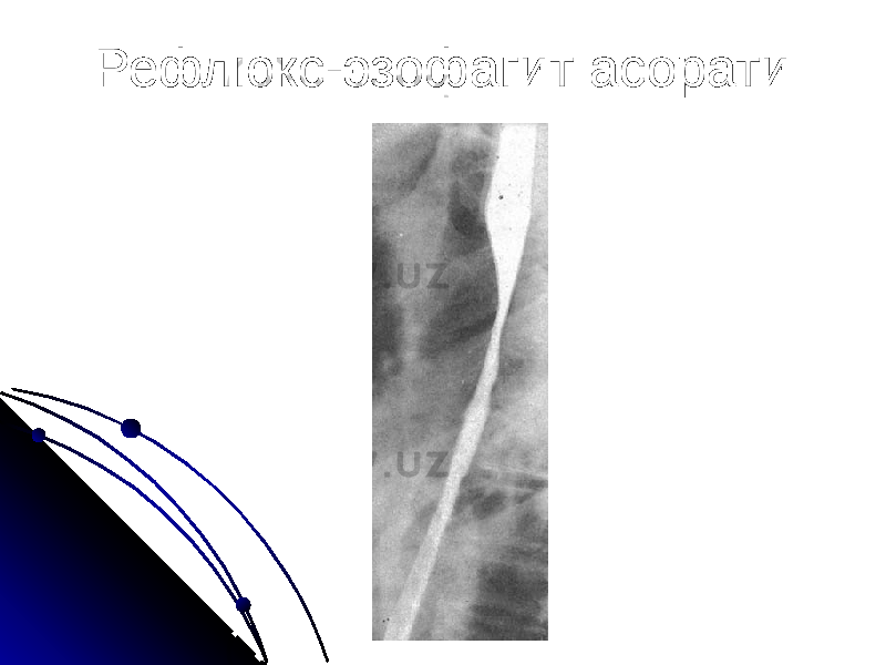 Рефлюкс-эзофагит асорати 