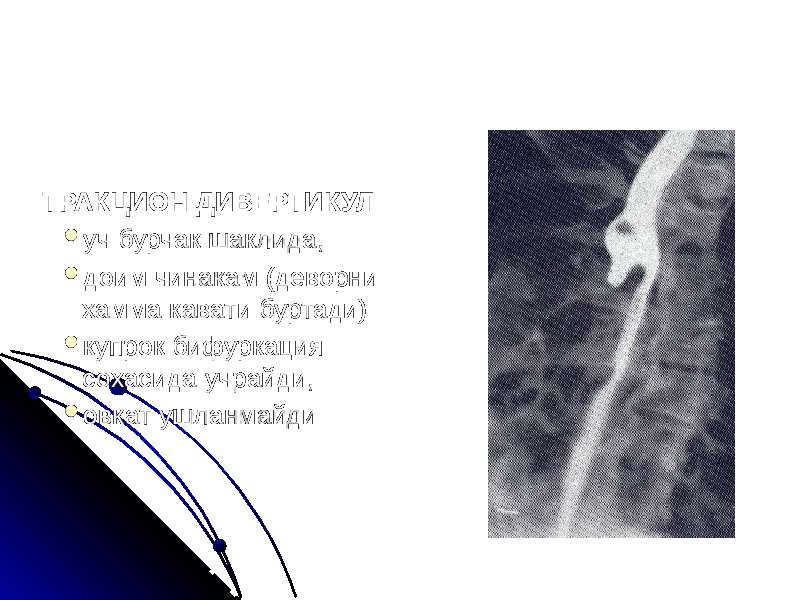 ТРАКЦИОН ДИВЕРТИКУЛ  уч бурчак шаклида,  доим чинакам (деворни хамма кавати буртади)  купрок бифуркация сохасида учрайди,  овкат ушланмайди 