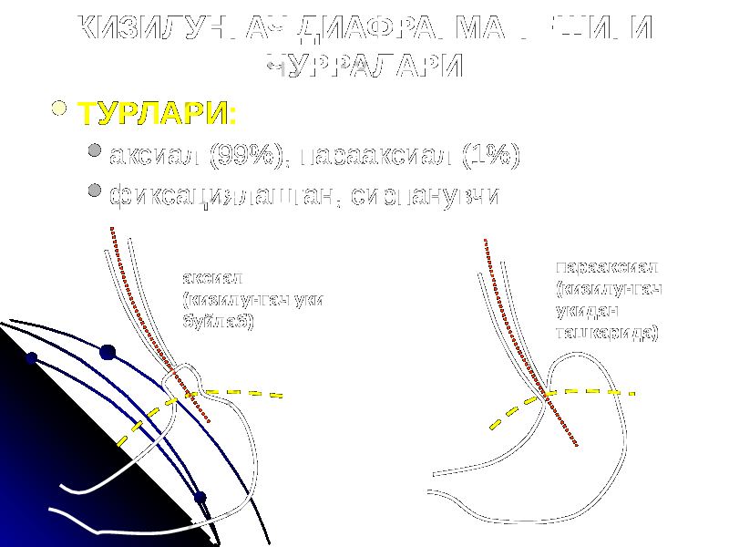 КИЗИЛУНГАЧ ДИАФРАГМА ТЕШИГИ ЧУРРАЛАРИ  ТУРЛАРИ:  аксиал (99%), парааксиал (1%)  фиксациялашган, сирпанувчи аксиал (кизилунгач уки буйлаб) парааксиал (кизилунгач укидан ташкарида) 