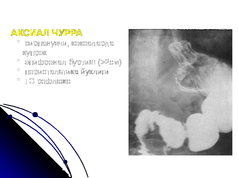 АКСИАЛ ЧУРРА • сирпанувчи, кексаларда купрок • эпифренал буртиш (>2см) • перистальтика йуклиги • ГЭ рефлюкс 