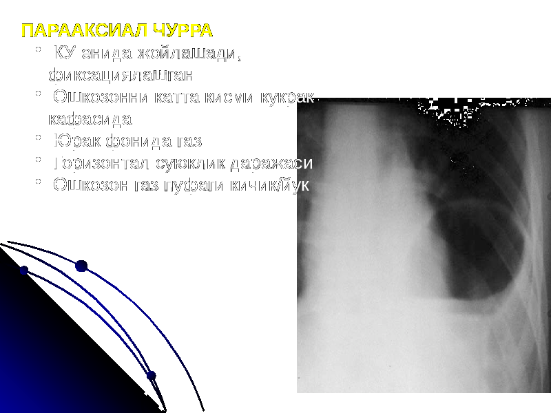 ПАРААКСИАЛ ЧУРРА • КУ енида жойлашади, фиксациялашган • Ошкозонни катта кисми кукрак кафасида • Юрак фонида газ • Горизонтал суюклик даражаси • Ошкозон газ пуфаги кичик/йук 