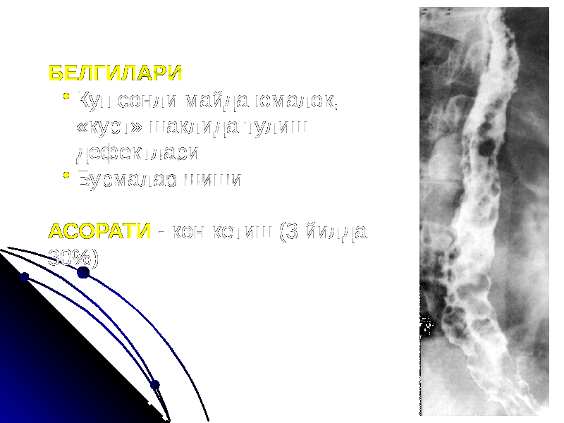 БЕЛГИЛАРИ • Куп сонли майда юмалок, «курт» шаклида тулиш дефектлари • Бурмалар шиши АСОРАТИ - кон кетиш (3 йилда 30%) 