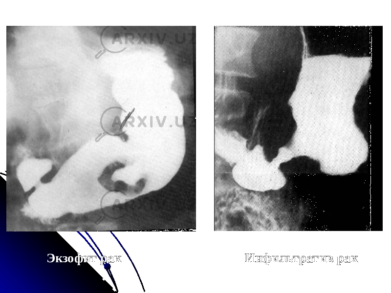  Экзофит рак Инфильтратив рак 