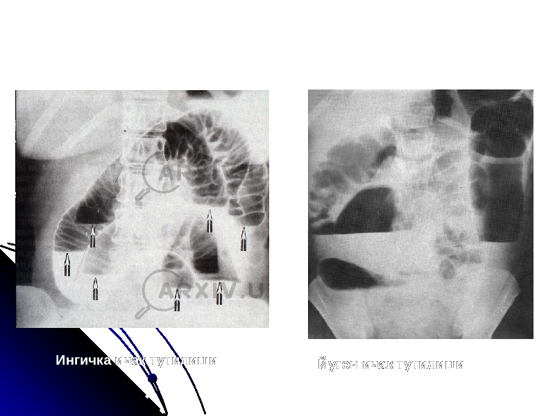 Ингичка ичак тутилиши Йугон ичак тутилиши 