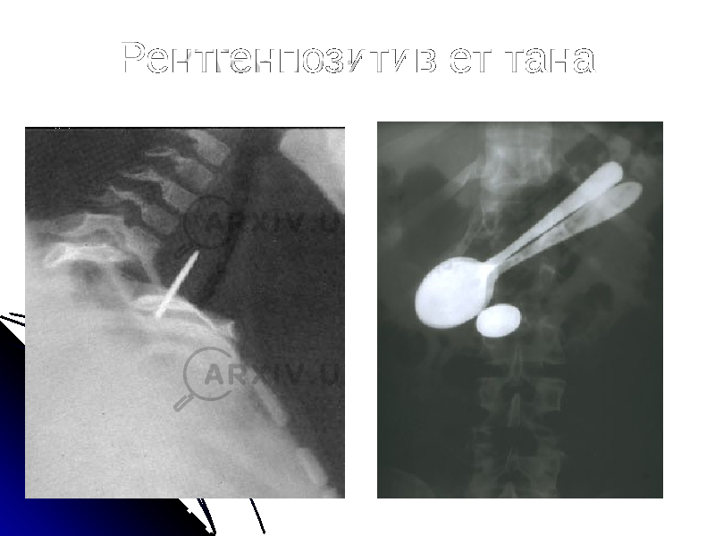 Рентгенпозитив ет тана 