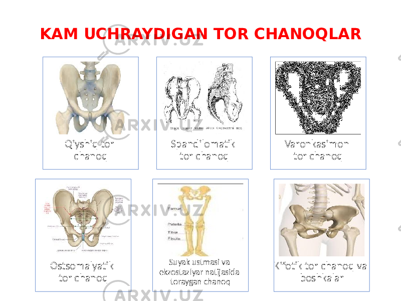 KAM UCHRAYDIGAN TOR CHANOQLAR Qiyshiq tor chanoq Spandilomatik tor chanoq Varonkasimon tor chanoq Ostsomalyatik tor chanoq Suyak ustmasi va ekzostazlyar natijasida toraygan chanoq Kifotik tor chanoq va boshkalar 