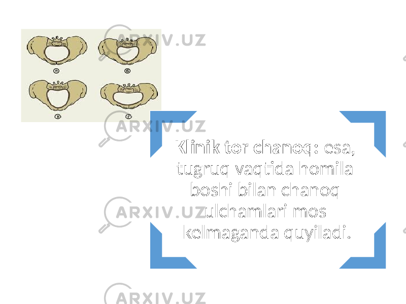 Klinik tor chanoq: esa, tugruq vaqtida homila boshi bilan chanoq ulchamlari mos kelmaganda quyiladi. 