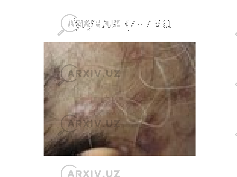 Тугунли қичима 