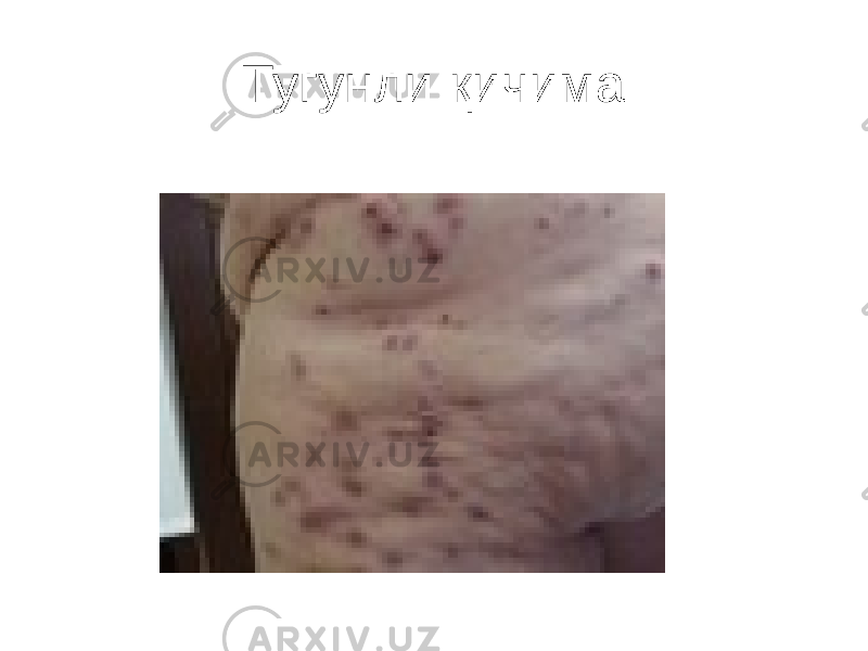 Тугунли қичима 