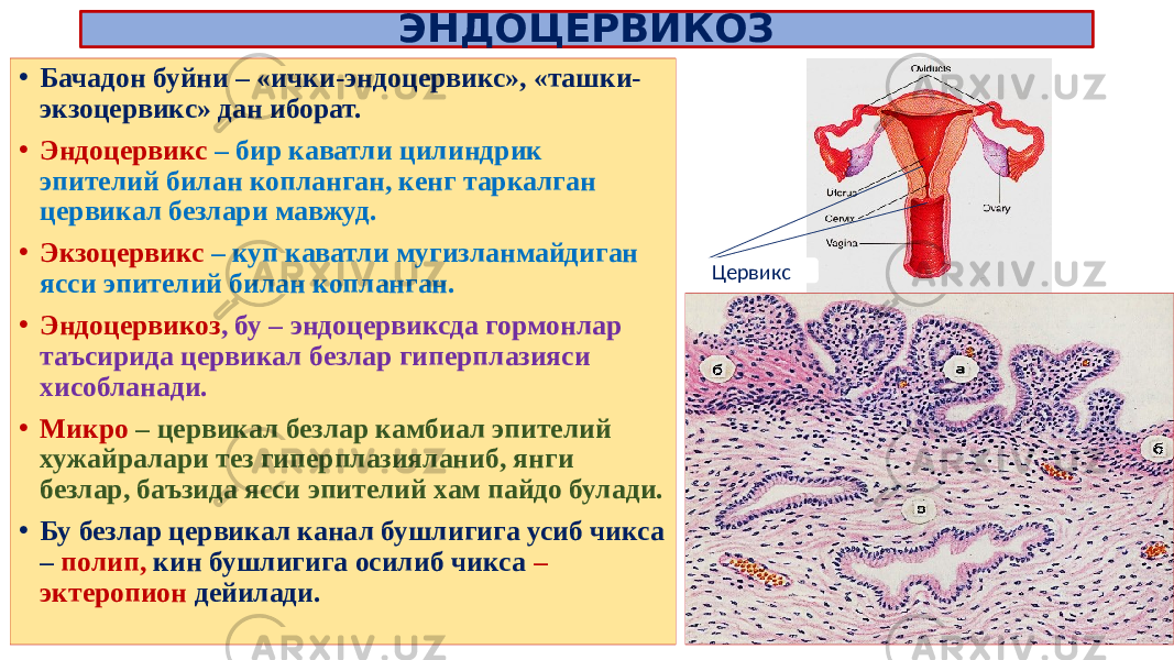 ЭНДОЦЕРВИКОЗ • Бачадон буйни – «ички-эндоцервикс», «ташки- экзоцервикс» дан иборат. • Эндоцервикс – бир каватли цилиндрик эпителий билан копланган, кенг таркалган цервикал безлари мавжуд. • Экзоцервикс – куп каватли мугизланмайдиган ясси эпителий билан копланган. • Эндоцервикоз , бу – эндоцервиксда гормонлар таъсирида цервикал безлар гиперплазияси хисобланади. • Микро – цервикал безлар камбиал эпителий хужайралари тез гиперплазияланиб, янги безлар, баъзида ясси эпителий хам пайдо булади. • Бу безлар цервикал канал бушлигига усиб чикса – полип, кин бушлигига осилиб чикса – эктеропион дейилади. Цервикс 