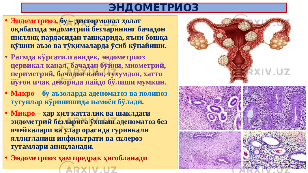 ЭНДОМЕТРИОЗ • Эндометриоз, бу – дисгормонал ҳолат оқибатида эндометрий безларининг бачадон шиллиқ пардасидан ташқарида, яъни бошқа қўшни аъзо ва тўқималарда ўсиб кўпайиши. • Расмда кўрсатилганидек, эндометриоз цервикал канал, бачадан бўйни, миометрий, периметрий, бачадон найи, тухумдон, хатто йўғон ичак деворида пайдо бўлиши мумкин. • Макро – бу аъзоларда аденоматоз ва полипоз тугунлар кўринишида намоён бўлади. • Микро – ҳар хил катталик ва шаклдаги эндометрий безларига ўхшаш аденоматоз без ячейкалари ва улар орасида суринкали яллиғланиш инфильтрати ва склероз тутамлари аниқланади. • Эндометриоз ҳам предрак ҳисобланади 