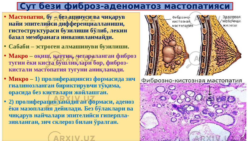 Сут бези фиброз-аденоматоз мастопатияси • Мастопатия , бу – без ацинуси ва чиқарув найи эпителийси дифференциалланиши, гистоструктураси бузилиши бўлиб, лекин базал мембранага инвазияланмайди. • Сабаби – эстроген алмашинуви бузилиши. • Макро – оқиш, қаттиқ, чегараланган фиброз тугин ёки киста бўшлиқлари бор, фиброз- кистали мастопатия тугуни аниқланади. • Микро – 1) пролиферациясиз формасида зич гиалинозланган бириктирувчи тўқима, орасида без кисталари жойлашган. • 2) пролиферацияланадиган формаси, аденоз ёки мазоплазия дейилади. Без бўлаклари ва чиқарув найчалари эпителийси гиперпла- зияланган, зич склероз билан ўралган. 