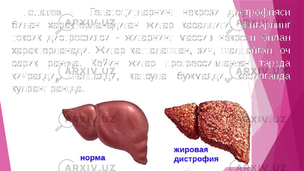 Гепатоз - Гепатоцитларнинг некрози дистрофияси билан характерланадиган жигар касаллиги. Жигарнинг токсик дистрофияси - жигарнинг массив некрози билан характерланади. Жигар катталашган, зич, шалпайган, оч сарик рангда. Кейин жигар прогрессивланган тарзда кичраяди, шалпаяди, капсула бужмаяди, кесилганда кулранг рангда. 