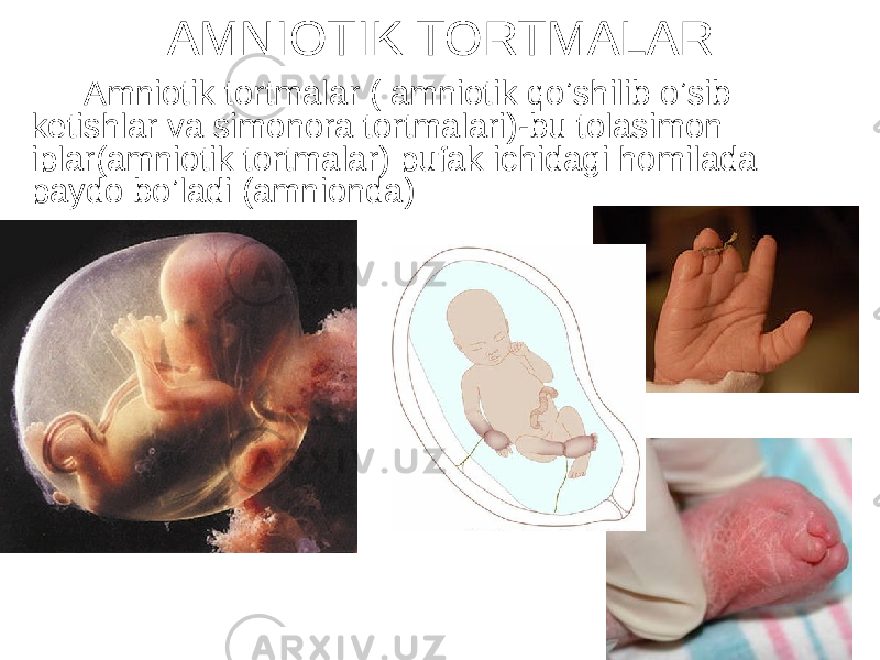 АMNIOTIK TORTMАLАR Аmniotik tortmalar ( amniotik qoʼshilib oʼsib ketishlar va simonora tortmalari)-bu tolasimon iplar(amniotik tortmalar) pufak ichidagi homilada paydo boʼladi (amnionda) 
