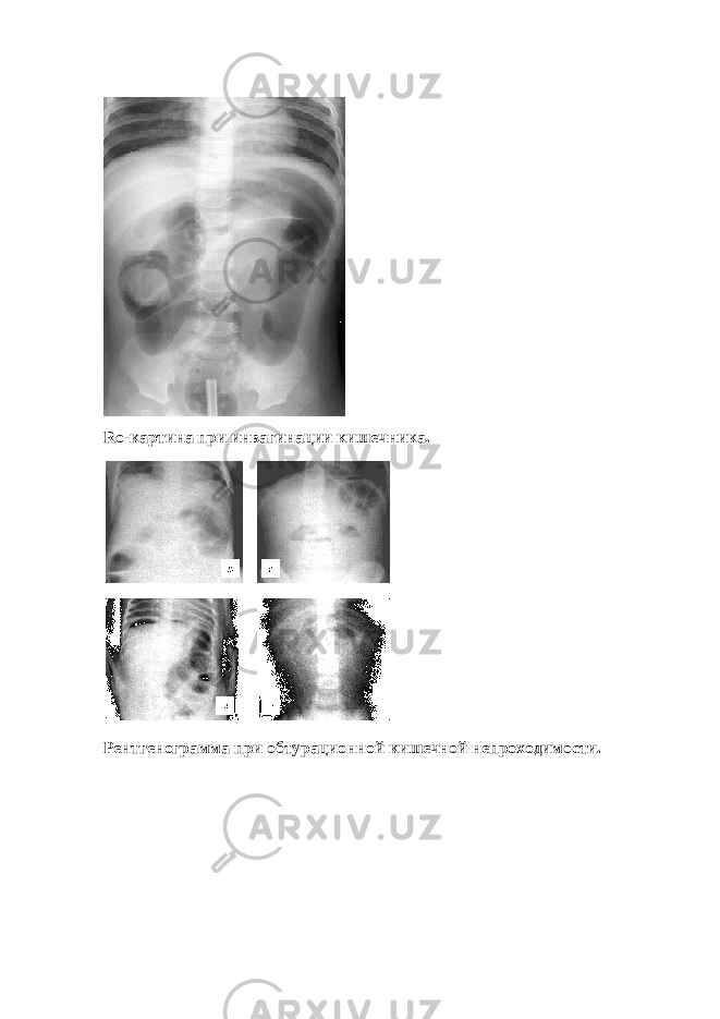 Ro -картина при инвагинации кишечника. Рентгенограмма при обтурационной кишечной непроходимости. 