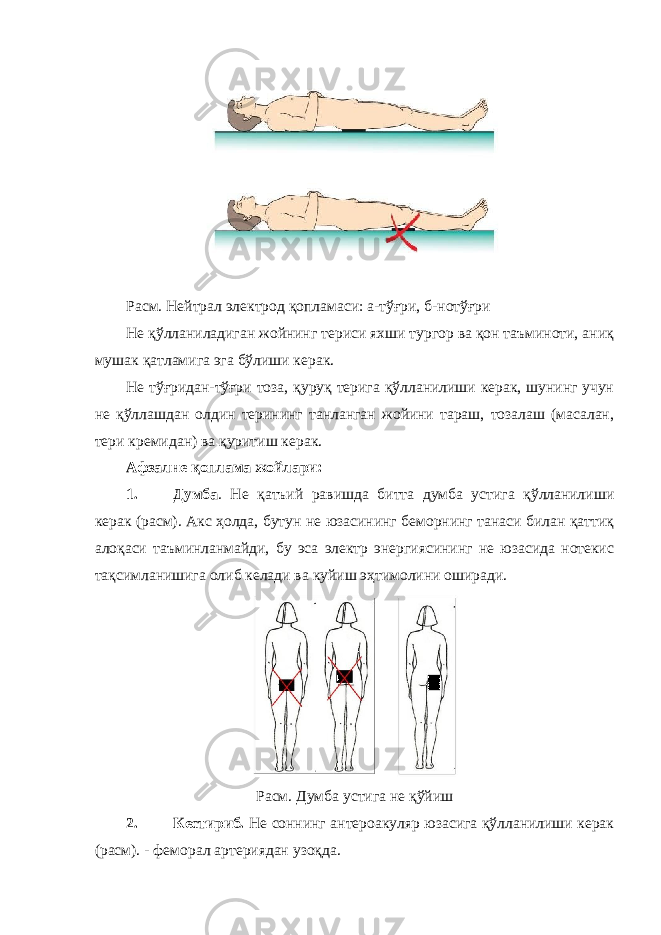 Расм. Нейтрал электрод қопламаси: а-тўғри, б-нотўғри Не қўлланиладиган жойнинг териси яхши тургор ва қон таъминоти, аниқ мушак қатламига эга бўлиши керак. Не тўғридан-тўғри тоза, қуруқ терига қўлланилиши керак, шунинг учун не қўллашдан олдин терининг танланган жойини тараш, тозалаш (масалан, тери кремидан) ва қуритиш керак. Афзалне қоплама жойлари: 1. Думба . Не қатъий равишда битта думба устига қўлланилиши керак (расм). Акс ҳолда, бутун не юзасининг беморнинг танаси билан қаттиқ алоқаси таъминланмайди, бу эса электр энергиясининг не юзасида нотекис тақсимланишига олиб келади ва куйиш эҳтимолини оширади. Расм. Думба устига не қўйиш 2. Кестириб. Не соннинг антероакуляр юзасига қўлланилиши керак (расм). - феморал артериядан узоқда. 