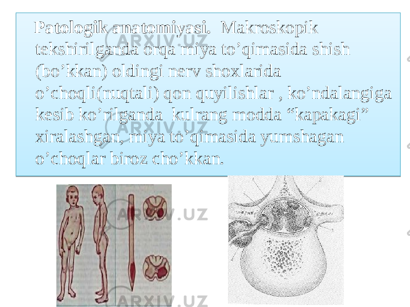  Patologik anatomiyasi. Makroskopik tekshirilganda orqa miya to’qimasida shish (bo’kkan) oldingi nerv shoxlarida o’choqli(nuqtali) qon quyilishlar , ko’ndalangiga kesib ko’rilganda kulrang modda “kapakagi” xiralashgan, miya to’qimasida yumshagan o’choqlar biroz cho’kkan. 05 0F 072F 030A 0C15 01 04 2A 01 