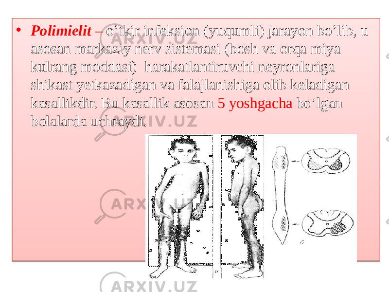 • Polimielit – o’tkir infeksion (yuqumli) jarayon bo’lib, u asosan markaziy nerv sistemasi (bosh va orqa miya kulrang moddasi) harakatlantiruvchi neyronlariga shikast yetkazadigan va falajlanishiga olib keladigan kasallikdir. Bu kasallik asosan 5 yoshgacha bo’lgan bolalarda uchraydi. 01 140C06 01 01 140B01 04 0B19 04 1F070D01 15 15 