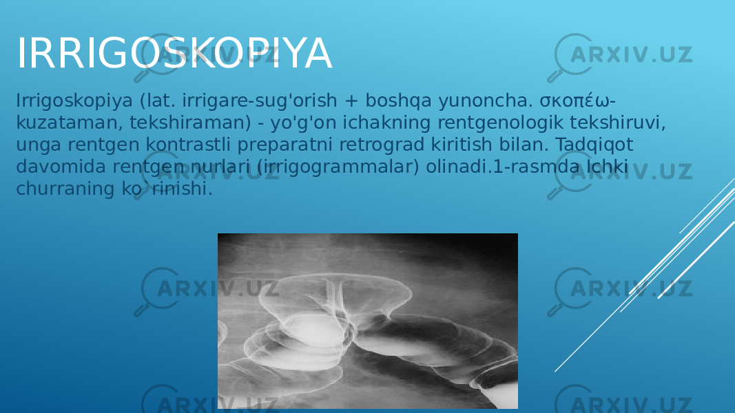 IRRIGOSKOPIYA Irrigoskopiya (lat. irrigare-sug&#39;orish + boshqa yunoncha. σκοπέω- kuzataman, tekshiraman) - yo&#39;g&#39;on ichakning rentgenologik tekshiruvi, unga rentgen kontrastli preparatni retrograd kiritish bilan. Tadqiqot davomida rentgen nurlari (irrigogrammalar) olinadi.1-rasmda Ichki churraning ko`rinishi. 