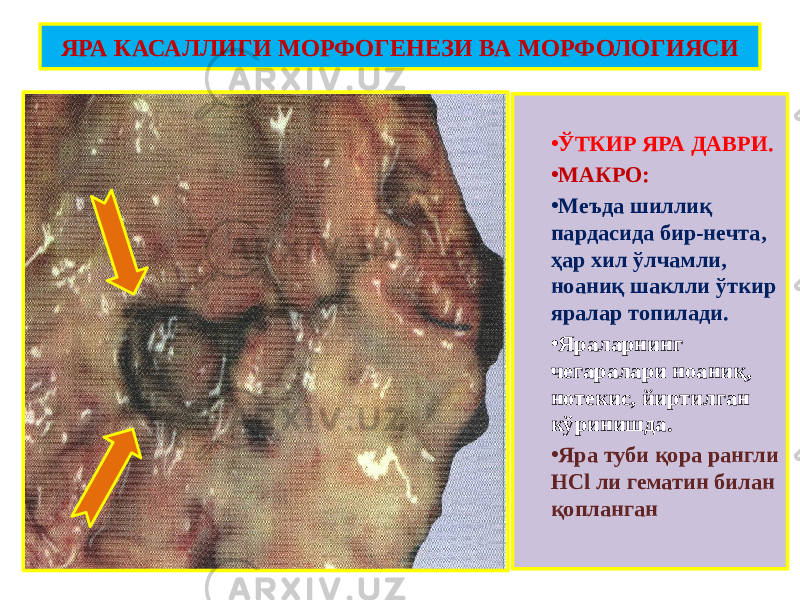 • ЎТКИР ЯРА ДАВРИ. • МАКРО: • Меъда шиллиқ пардасида бир-нечта, ҳар хил ўлчамли, ноаниқ шаклли ўткир яралар топилади. • Яраларнинг чегаралари ноаниқ, нотекис, йиртилган кўринишда. • Яра туби қора рангли HCl ли гематин билан қопланганЯРА КАСАЛЛИГИ МОРФОГЕНЕЗИ ВА МОРФОЛОГИЯСИ 