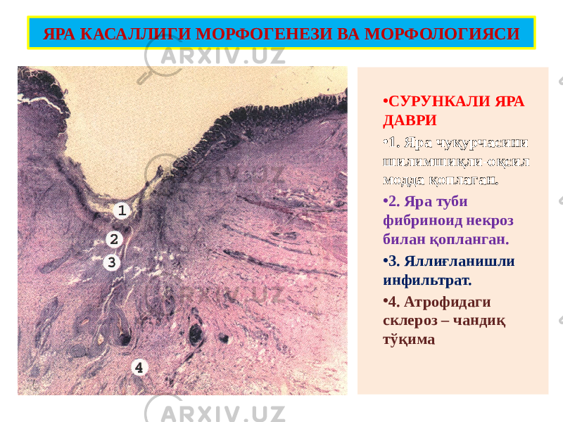 • СУРУНКАЛИ ЯРА ДАВРИ • 1. Яра чуқурчасини шилимшиқли-оқсил модда қоплаган. • 2. Яра туби фибриноид некроз билан қопланган. • 3. Яллиғланишли инфильтрат. • 4. Атрофидаги склероз – чандиқ тўқимаЯРА КАСАЛЛИГИ МОРФОГЕНЕЗИ ВА МОРФОЛОГИЯСИ 