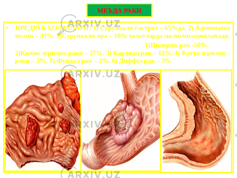 МЕЪДА РАКИ • ПРЕДРАК ҲОЛАТЛАРИ: 1) Сурункали гастрит – 65%да. 2) Аденоматоз полип – 35%. 3)Сурункали яра – 10% ҳолатларда малигнизацияланади. • ЖОЙЛАНИШИ БЎЙИЧА ФОРМАЛАРИ: 1)Пилорик рак -50%. 2)Кичик эгрилик раки – 27%. 3) Кардиал рак – 15%. 4) Катта эгрилик раки – 3%. 5) Фундал рак – 2%. 6) Диффуз рак – 3% 