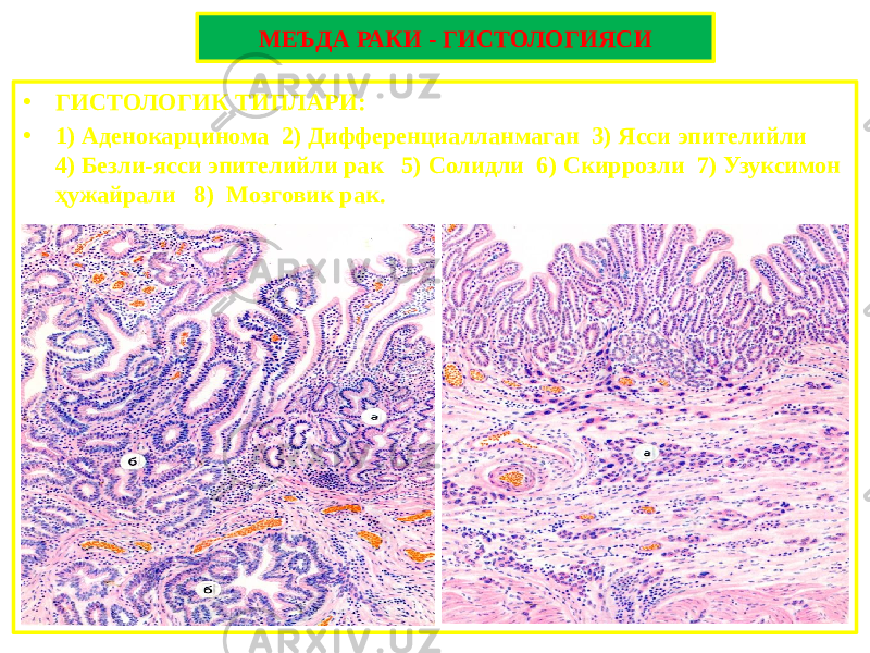 МЕЪДА РАКИ - ГИСТОЛОГИЯСИ • ГИСТОЛОГИК ТИПЛАРИ: • 1) Аденокарцинома 2) Дифференциалланмаган 3) Ясси эпителийли 4) Безли-ясси эпителийли рак 5) Солидли 6) Скиррозли 7) Узуксимон ҳужайрали 8) Мозговик рак. 