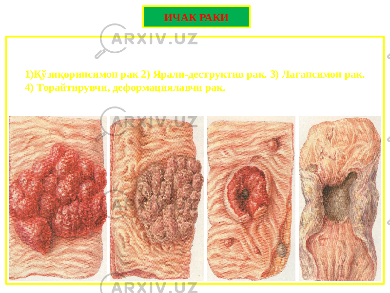 ИЧАК РАКИ • ИЧАК РАКИНИНГ МАРКОСКОПИК ФОРМАЛАРИ: 1)Қўзиқоринсимон рак 2) Ярали-деструктив рак. 3) Лагансимон рак. 4) Торайтирувчи, деформациялавчи рак. 