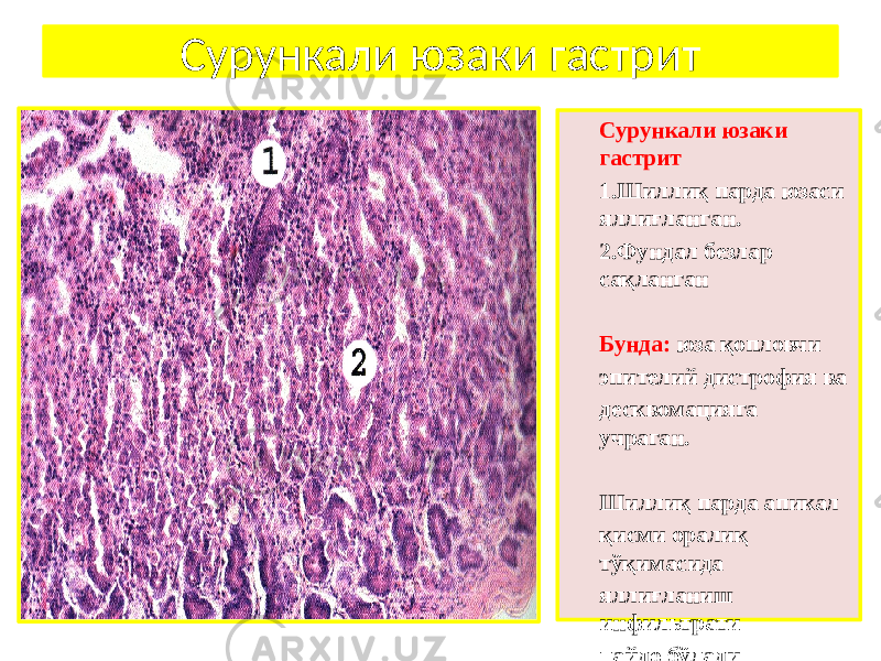 Сурункали юзаки гастрит Сурункали юзаки гастрит 1. Шиллиқ парда юзаси яллиғланган. 2. Фундал безлар сақланган Бунда: юза қопловчи эпителий дистрофия ва десквомацияга учраган. Шиллиқ парда апикал қисми оралиқ тўқимасида яллиғланиш инфильтрати пайдо бўлади 