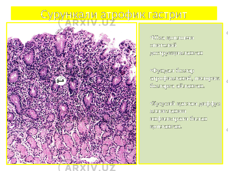 • Юза қопловчи эпителий деструкцияланган • Фундал безлар атрофияланиб, пилорик безларга айланган. • Хусусий қатлам диффуз яллиғланиш инфильтрати билан қопланган.Сурункали атрофик гастрит 