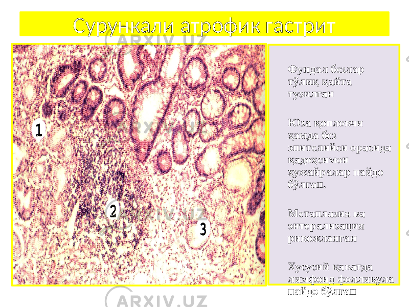 Фундал безлар тўлиқ қайта тузилган Юза қопловчи ҳамда без эпителийси орасида қадоҳсимон ҳужайралар пайдо бўлган. Метаплазия ва энтерализация ривожланган Хусусий қаватда лимфоид фолликула пайдо бўлганСурункали атрофик гастрит 