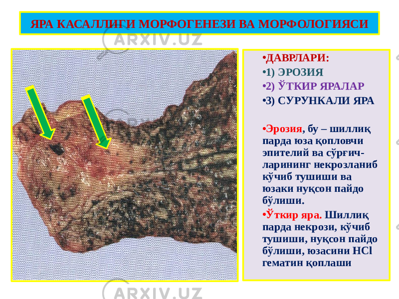 ЯРА КАСАЛЛИГИ МОРФОГЕНЕЗИ ВА МОРФОЛОГИЯСИ • ДАВРЛАРИ: • 1) ЭРОЗИЯ • 2) ЎТКИР ЯРАЛАР • 3) СУРУНКАЛИ ЯРА • Эрозия , бу – шиллиқ парда юза қопловчи эпителий ва сўрғич- ларининг некрозланиб кўчиб тушиши ва юзаки нуқсон пайдо бўлиши. • Ўткир яра. Шиллиқ парда некрози, кўчиб тушиши, нуқсон пайдо бўлиши, юзасини HCl гематин қоплаши 