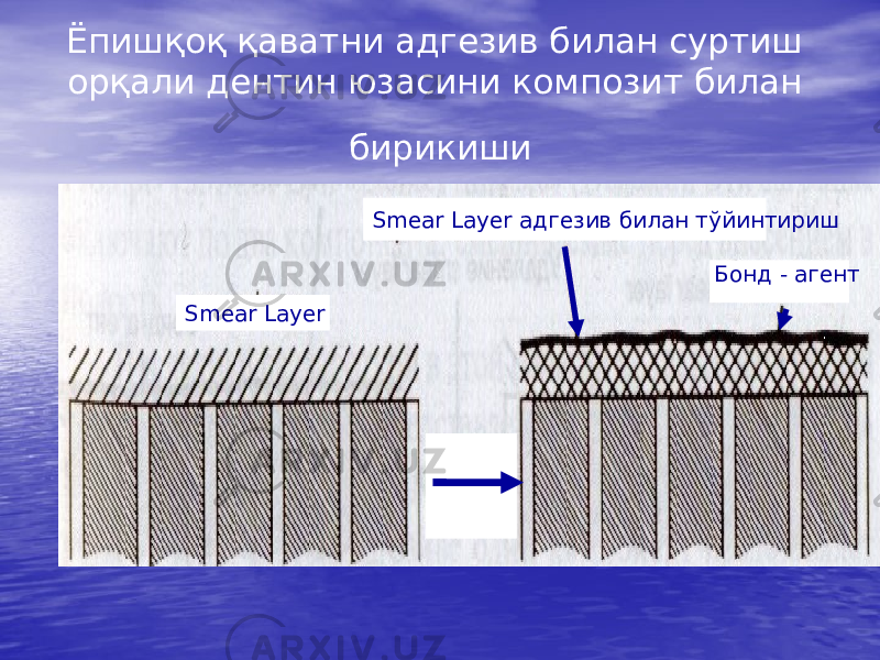 Ёпишқоқ қаватни адгезив билан суртиш орқали дентин юзасини композит билан бирикиши Smear Layer адгезив билан тўйинтириш Smear Layer Бонд - агент 