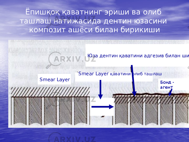 Ёпишқоқ қаватнинг эриши ва олиб ташлаш натижасида дентин юзасини композит ашёси билан бирикиши Smear Layer Smear Layer қаватини олиб ташлашБ он д - аген тЮза дентин қаватини адгезив билан шимдириш 