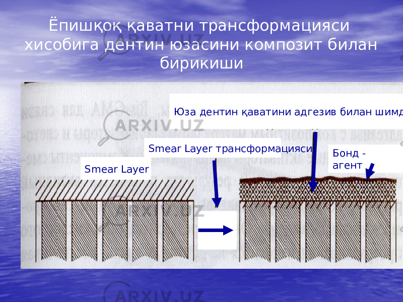 Ёпишқоқ қаватни трансформацияси хисобига дентин юзасини композит билан бирикиши Бонд - агент Smear Layer Юза дентин қаватини адгезив билан шимдириш Smear Layer трансформацияси 