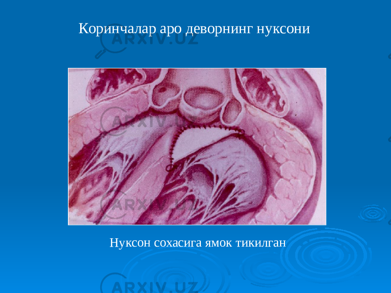 Нуксон сохасига ямок тикилганКоринчалар аро деворнинг нуксони 