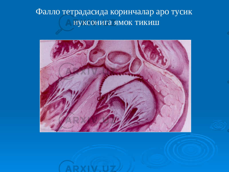 Фалло тетрадасида коринчалар аро тусик нуксонига ямок тикиш 