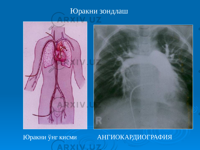 Юракни зондлаш Юракни ўнг кисми АНГИОКАРДИОГРАФИЯ 