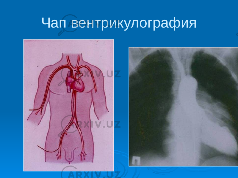 Чап вентрикулография 