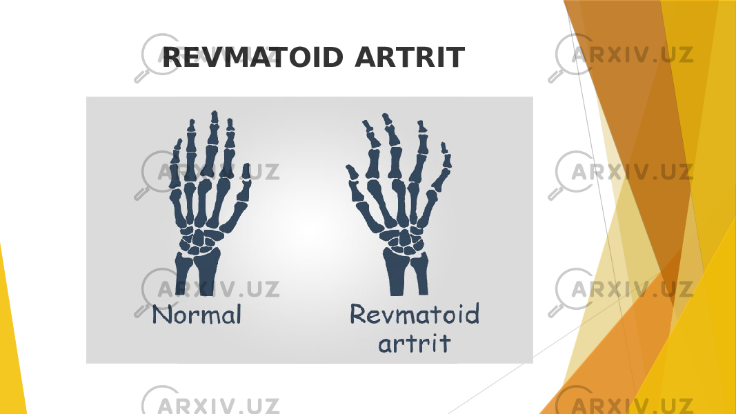  REVMATOID ARTRIT 