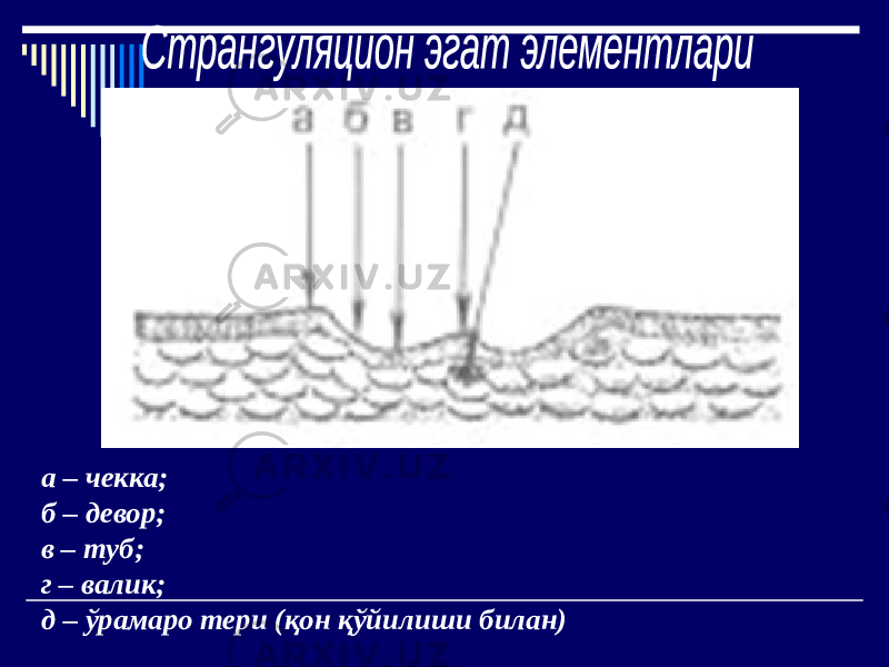 а – чекка; б – девор; в – туб; г – валик; д – ўрамаро тери (қон қўйилиши билан) 