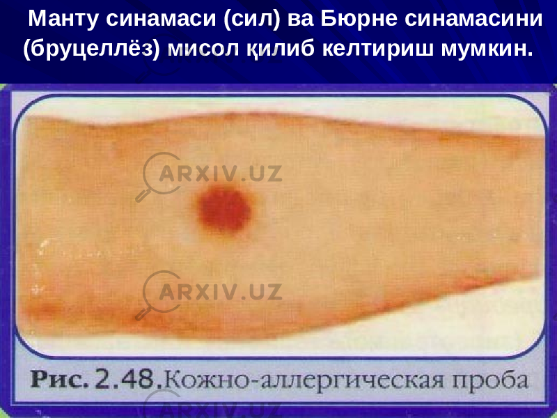 Манту синамаси (сил) ва Бюрне синамасини (бруцеллёз) мисол қилиб келтириш мумкин. 