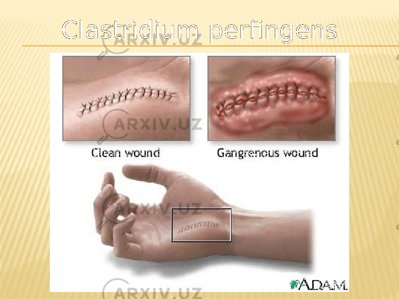 Clastridium perfingens 