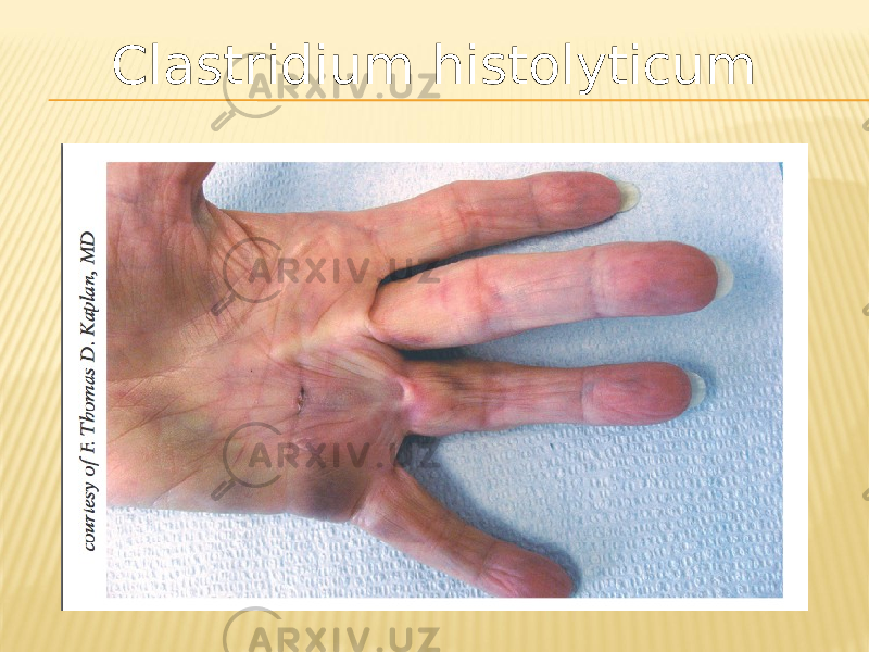 Clastridium histolyticum 