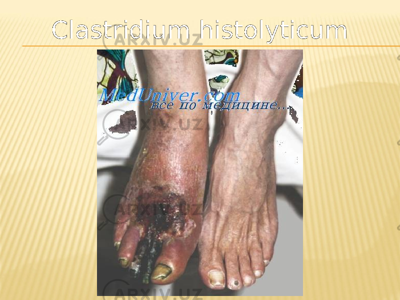 Clastridium histolyticum 