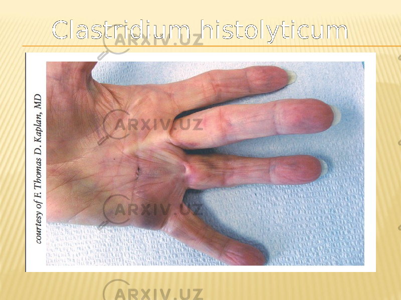 Clastridium histolyticum 