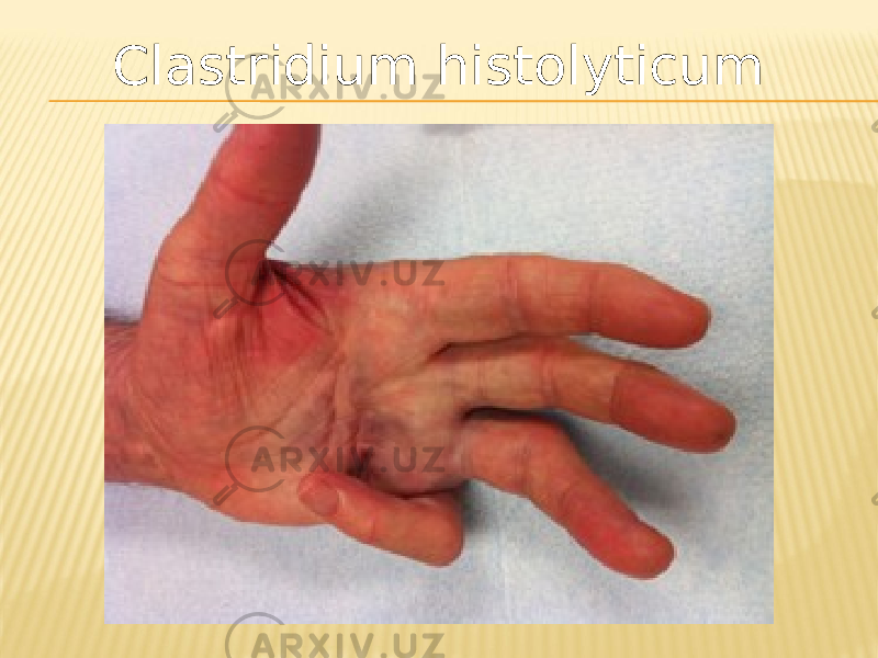 Clastridium histolyticum 