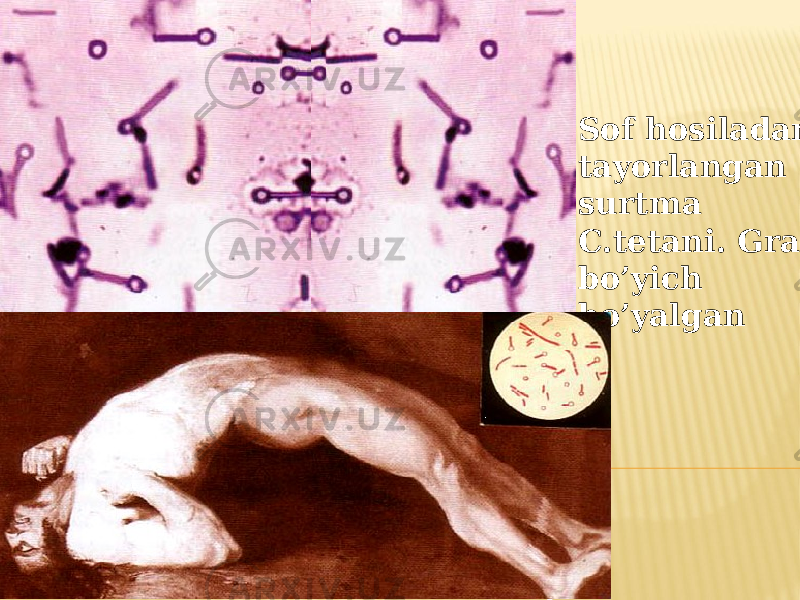 Опистотонус Sof hosiladan tayorlangan surtma C.tetani. Gram bo’yich bo’yalgan 