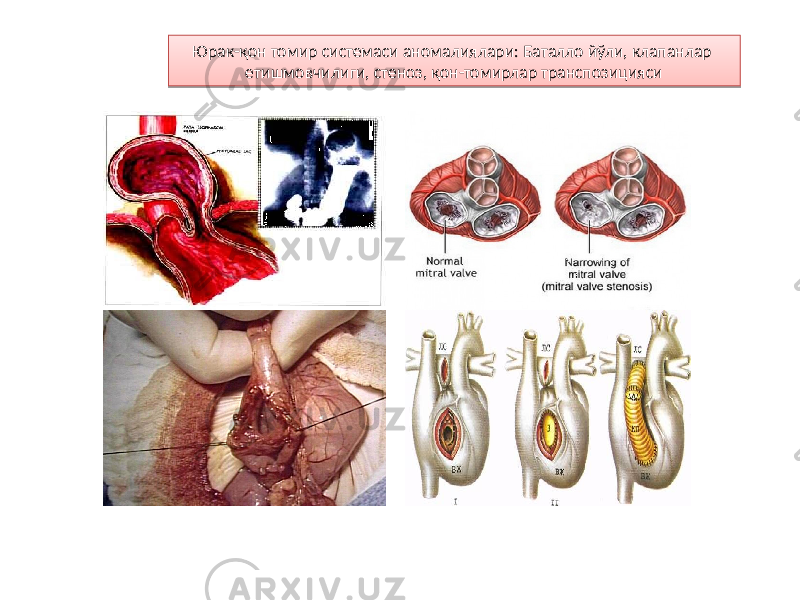 Юрак-қон томир системаси аномалиялари: Баталло йўли, клапанлар етишмовчилиги, стеноз, қон-томирлар транспозицияси87 06 